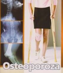 OSTEOPOROZA